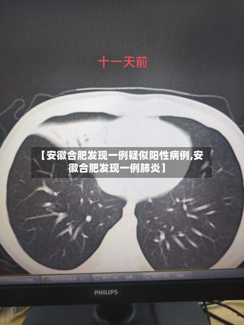 【安徽合肥发现一例疑似阳性病例,安徽合肥发现一例肺炎】-第2张图片