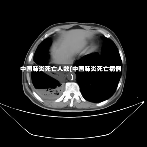 中国肺炎死亡人数(中国肺炎死亡病例)-第2张图片